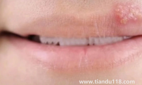 帶狀皰疹結痂后里面有膿咋辦3