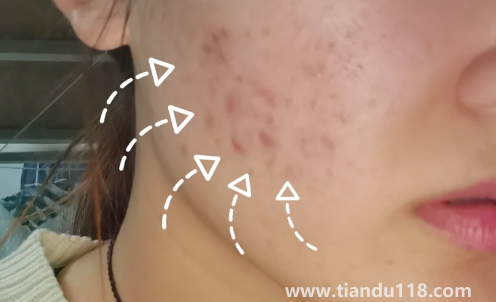 好幾年的痘印還發(fā)紅還能好嗎(皮膚不好有痘印怎么辦)(圖2) 好幾年的痘印還發(fā)紅還能好嗎2